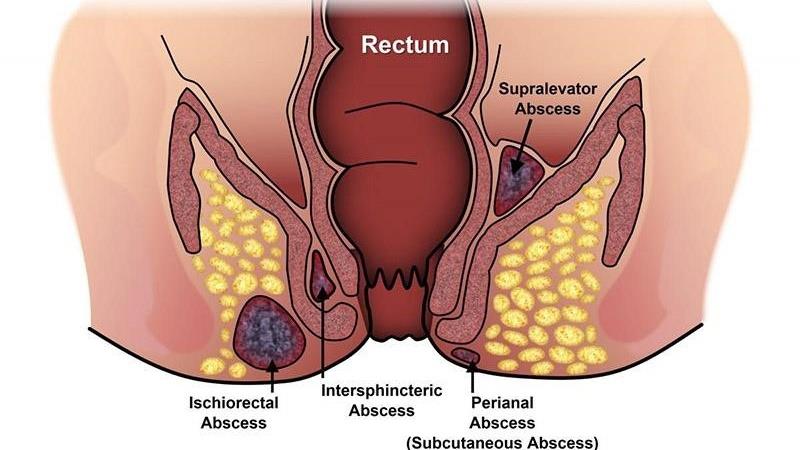 Anus smells bad: Causes and solutions